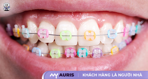 niềng răng mắc cài màu,niềng răng 7 màu,niềng răng màu,niềng răng màu sắc,niềng răng màu trắng,niềng răng nhiều màu,niềng răng thun màu