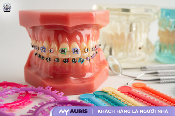 niềng răng mắc cài màu,niềng răng 7 màu,niềng răng màu,niềng răng màu sắc,niềng răng màu trắng,niềng răng nhiều màu,niềng răng thun màu