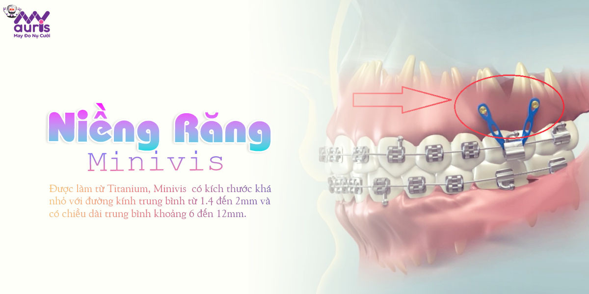 niềng răng minivis