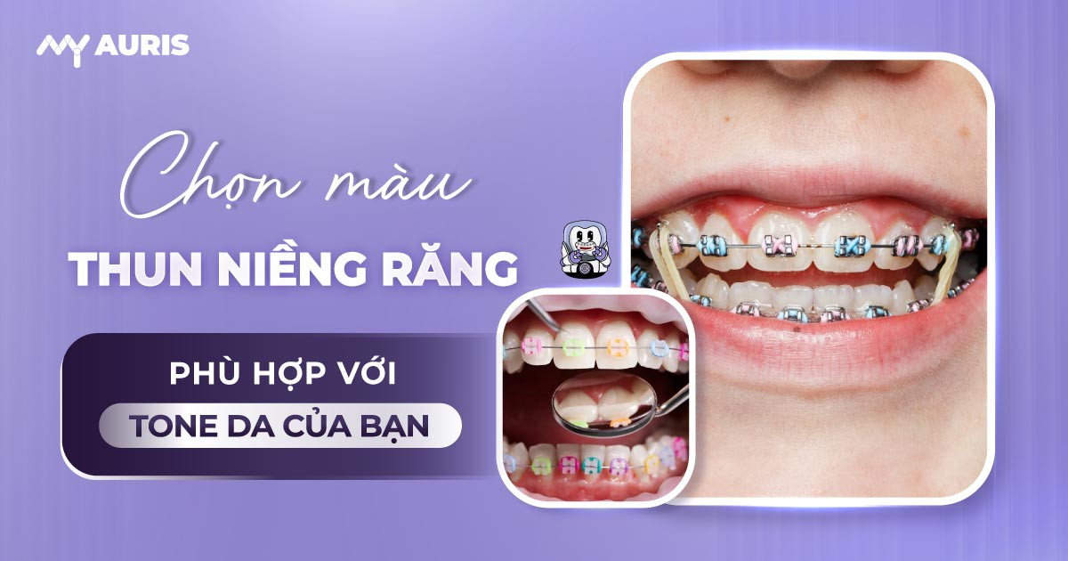 niềng răng thun màu,niềng răng 7 màu,niềng răng màu,niềng răng màu sắc,niềng răng màu trắng,niềng răng mắc cài màu,niềng răng nhiều màu