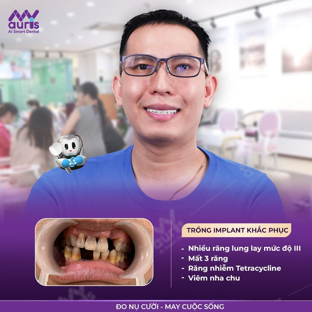 trồng răng giả bằng phương pháp implant