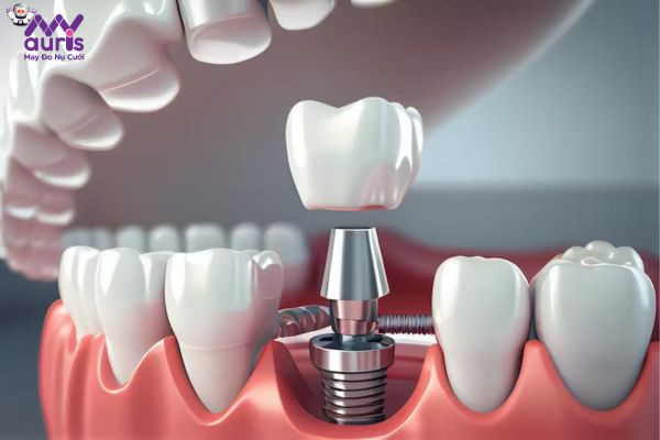 Trồng răng bằng trụ Implant là kỹ thuật gì?