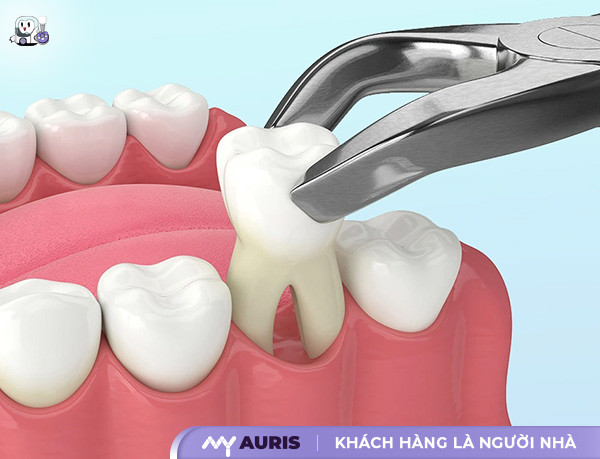 răng 7,răng số 7,vị trí răng số 7,răng số 7 là răng gì,nhổ răng số 7,răng số 7 có thay không,nhổ răng số 7 hàm trên có nguy hiểm không