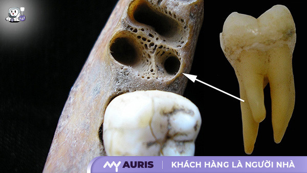 răng 7,răng số 7,vị trí răng số 7,răng số 7 là răng gì,nhổ răng số 7,răng số 7 có thay không,nhổ răng số 7 hàm trên có nguy hiểm không