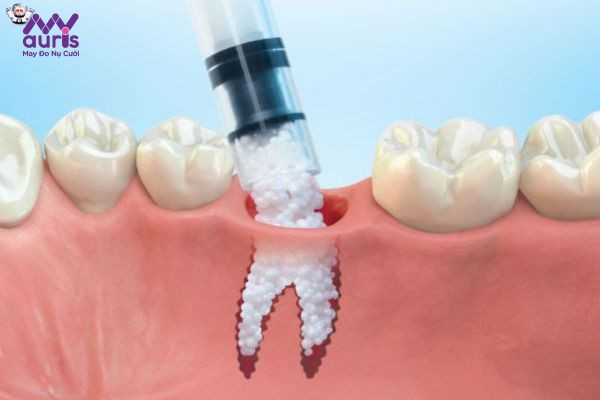 Những điểm lưu ý khi ghép xương trồng Implant 