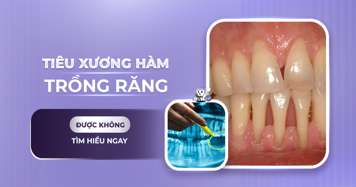 tiêu xương hàm có trồng răng được không ,trồng răng implant bị tiêu xương ,trồng răng implant khi bị tiêu xương hàm ,trồng răng khi bị tiêu xương hàm