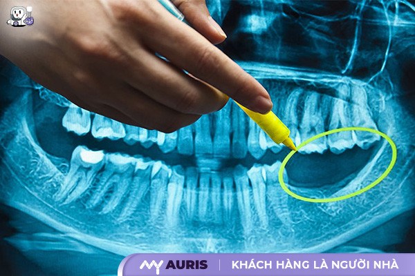 tiêu xương hàm có trồng răng được không ,trồng răng implant bị tiêu xương ,trồng răng implant khi bị tiêu xương hàm ,trồng răng khi bị tiêu xương hàm