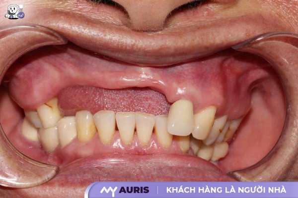 tiêu xương hàm có trồng răng được không ,trồng răng implant bị tiêu xương ,trồng răng implant khi bị tiêu xương hàm ,trồng răng khi bị tiêu xương hàm