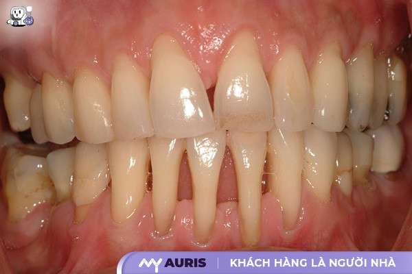 tiêu xương hàm có trồng răng được không ,trồng răng implant bị tiêu xương ,trồng răng implant khi bị tiêu xương hàm ,trồng răng khi bị tiêu xương hàm