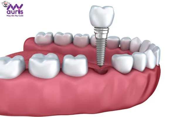 Trồng Implant 