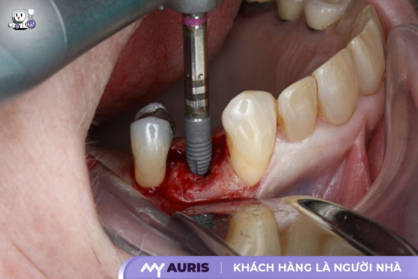 Trồng răng implant có nguy hiểm không