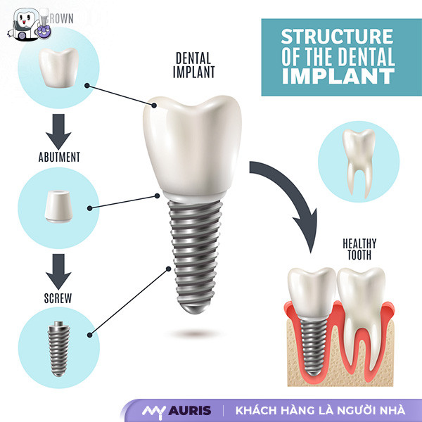 implant,trồng răng implant,răng implant,implant răng,trồng implant,cấy răng implant,implant là gì,implant nha khoa,trong rang implant,cắm răng implant,trồng răng implant là gì,răng implant là gì,làm răng implant,trồng răng implant,implant là gì,implant răng là gì,cắm implant,cấy implant,gắn implant là gì,trồng răng hàm implant,cắm trụ răng,tìm hiểu về trồng răng implant,cấy ghép implant là gì,trồng implant răng hàm,implant nha khoa là gì,cắm implant,cấy răng,làm răng implant là gì,cấy implant là gì,nha khoa implant,cắm implant là gì,gắn implant,