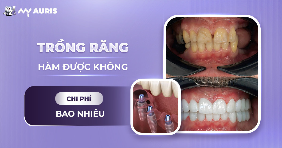 trồng răng hàm được không