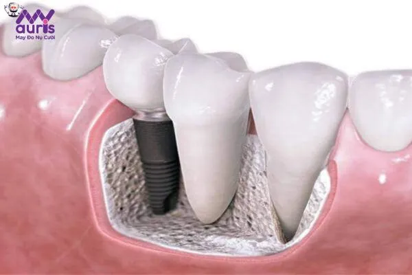 Vì sao nên thực hiện trồng răng hàm nhai?