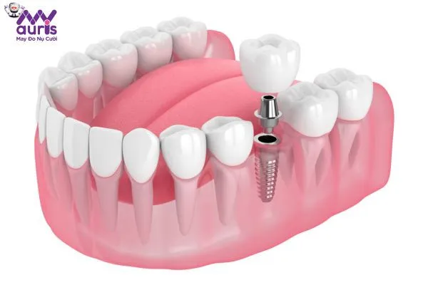 Trồng răng hàm nhai được không? - Phục hình an toàn bằng Implant 