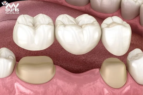 Bắc cầu răng sứ cải thiện khả năng ăn nhai 