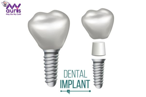 Trồng răng hàm số 7 giá bao nhiêu? - Kỹ thuật trồng răng Implant