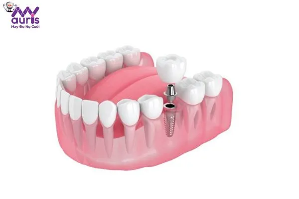 Vì sao lại có dịch vụ trồng răng Implant 3 triệu giá rẻ?