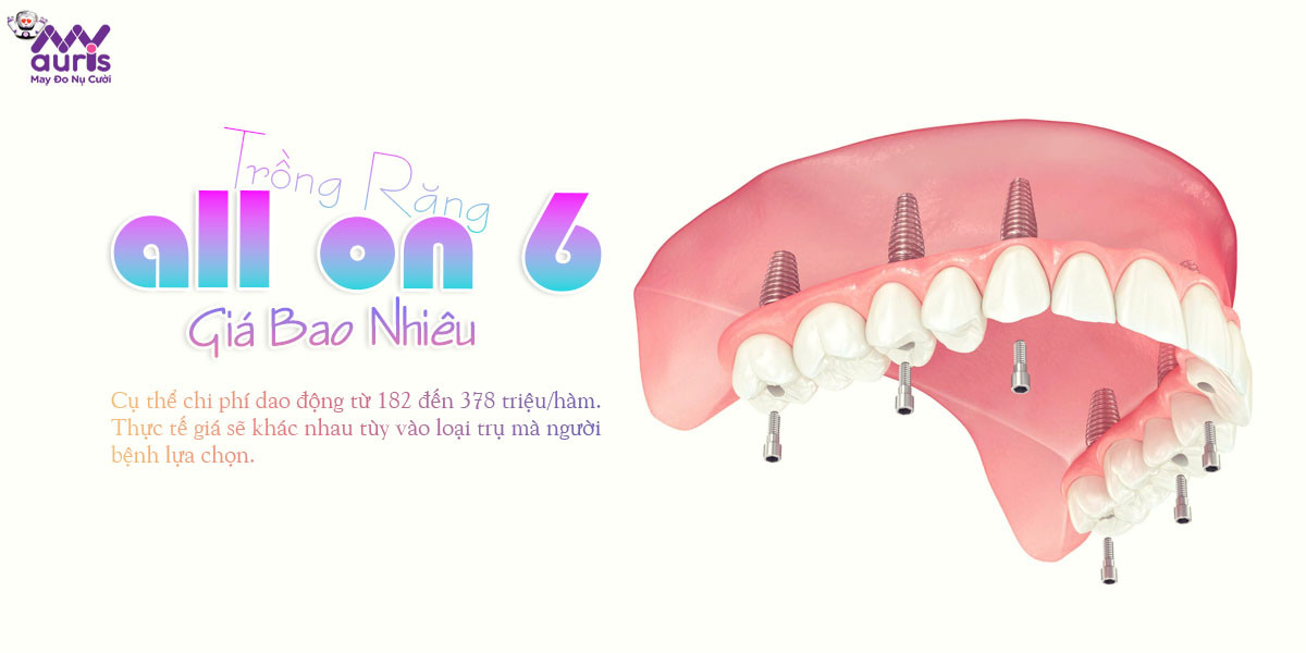 trồng răng implant all on 6 giá bao nhiêu