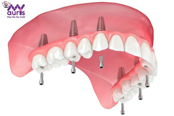 Giải đáp nha khoa: Trồng răng Implant All On 6 giá bao nhiêu?