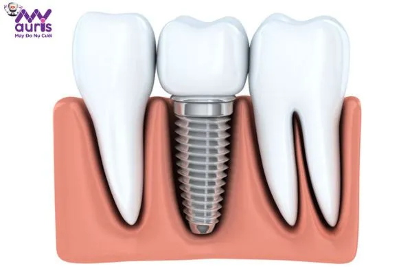 Giải đáp trồng răng Implant có an toàn không?