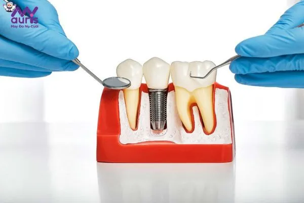 Yếu tố ảnh hưởng tính an toàn trong trồng răng Implant