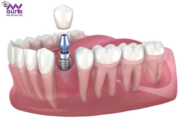 Trồng răng Implant có gây nguy hiểm không?