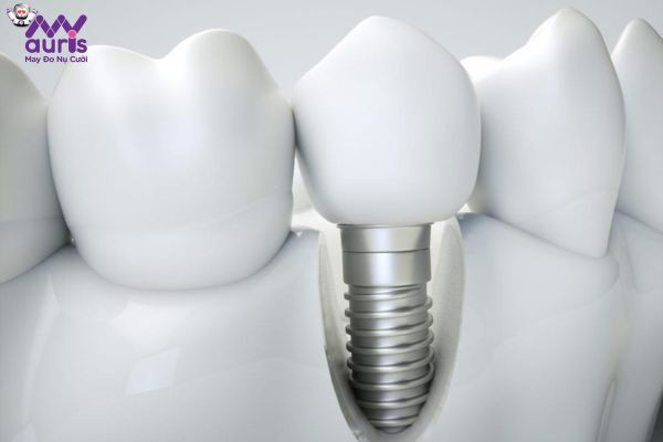 Trồng răng Implant 