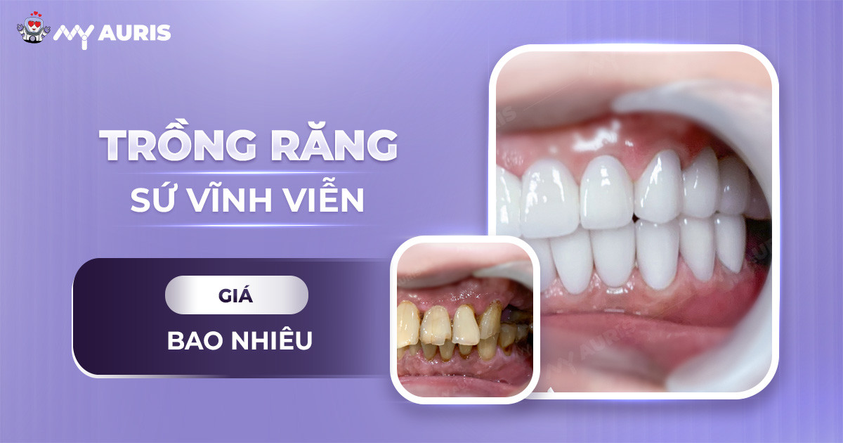 trong-rang-su-vinh-vien-gia-bao-nhieu-07