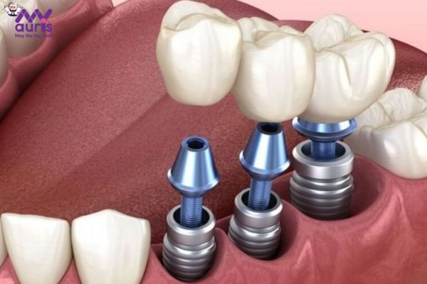 Trồng răng Implant 