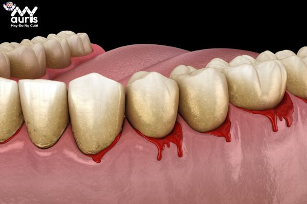 Các nguyên nhân gây hiện tượng chảy máu chân răng