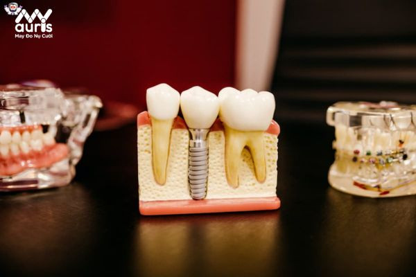 Ai nên trồng răng Implant?