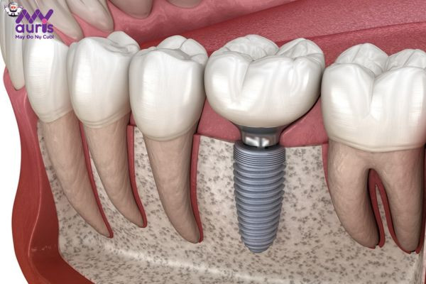 Điểm nổi bật của kỹ thuật trồng Implant 