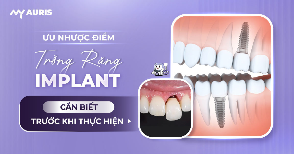 nhược điểm trồng răng implant,ưu nhược điểm cắm implant,ưu nhược điểm của cấy implant