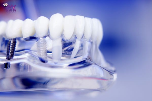 phương pháp trồng răng implant mới 