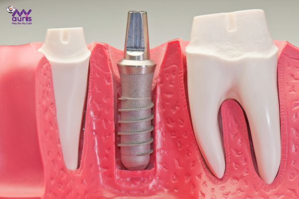 phương pháp trồng răng implant