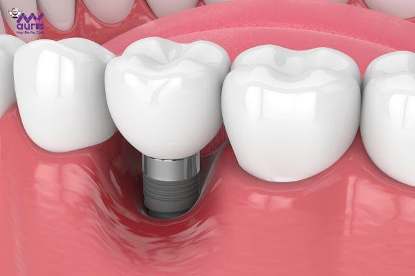 phương pháp trồng răng implant mới 