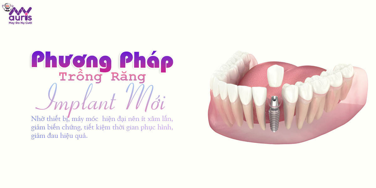 phương pháp trồng răng implant mới