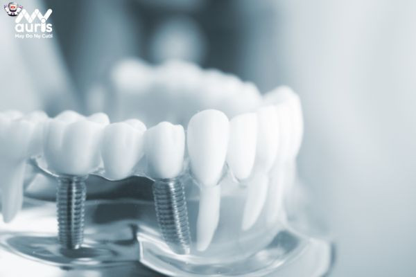 Trồng răng Implant có tác dụng phụ không? 