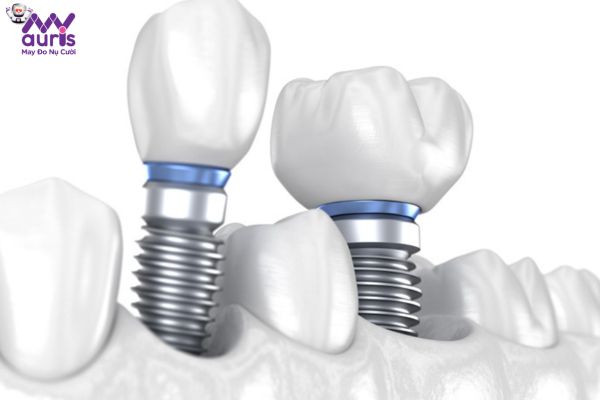 Trồng Implant có gây ảnh hưởng gì không?