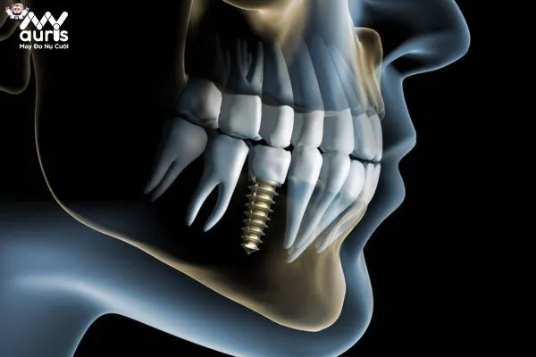 Quy trình thực hiện ghép xương trước khi trồng Implant 