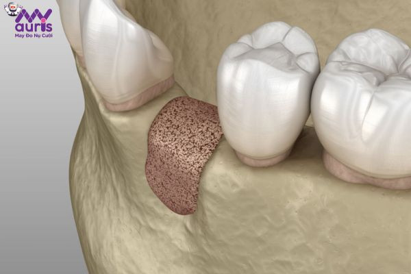 Thực hiện trồng răng Implant khi bị tiêu xương hàm được không?