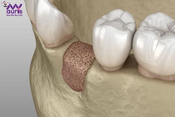 Thực hiện trồng răng Implant khi bị tiêu xương hàm được không?