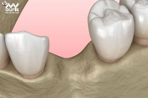 Hậu quả nguy hiểm khi tiêu xương hàm trong trồng Implant 