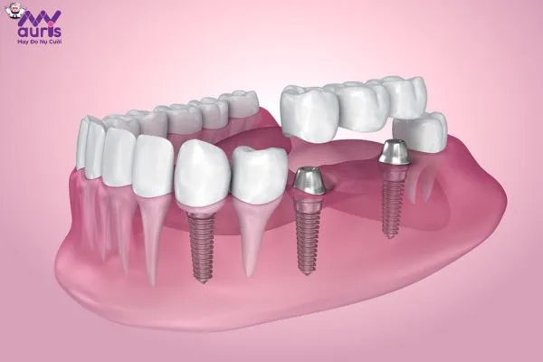Tiêu chí đánh giá trồng răng Implant ở đâu tốt nhất?