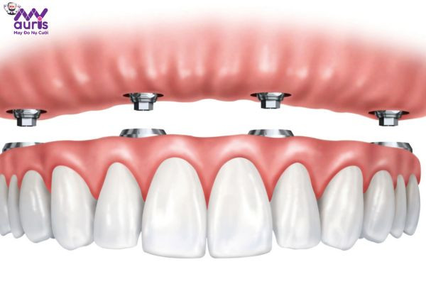 Trồng răng Implant toàn hàm là phương pháp gì?