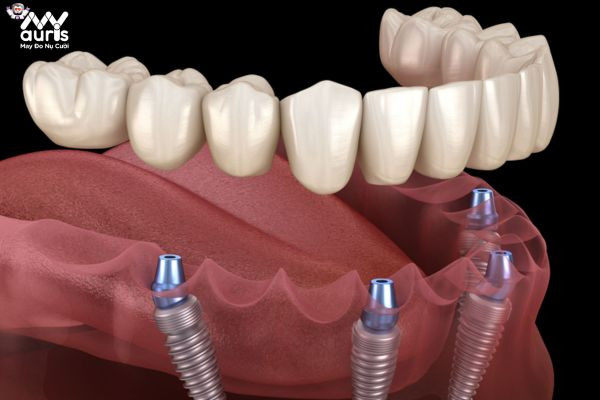 Ai nên thực hiện trồng Implant nguyên hàm?