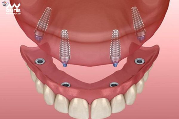 Vì sao trồng Implant All on 4, All on 6 được đánh giá tốt nhất hiện nay?