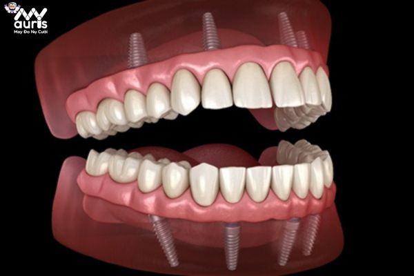 Nên lưu ý gì sau khi trồng Implant toàn hàm?