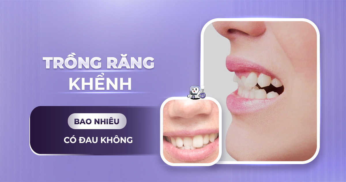 trồng răng khểnh,trồng răng khểnh giá bao nhiêu,trồng răng khểnh bao nhiêu tiền